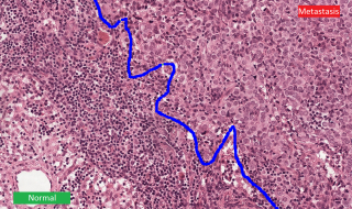 Uitzaaiingen (metastase) - data afkomstig uit het onderzoek van Bas Veeling