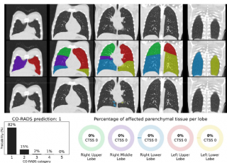 CT-scans van longen met negatieve CORADS-uitslag