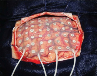Electrode grid on brain
