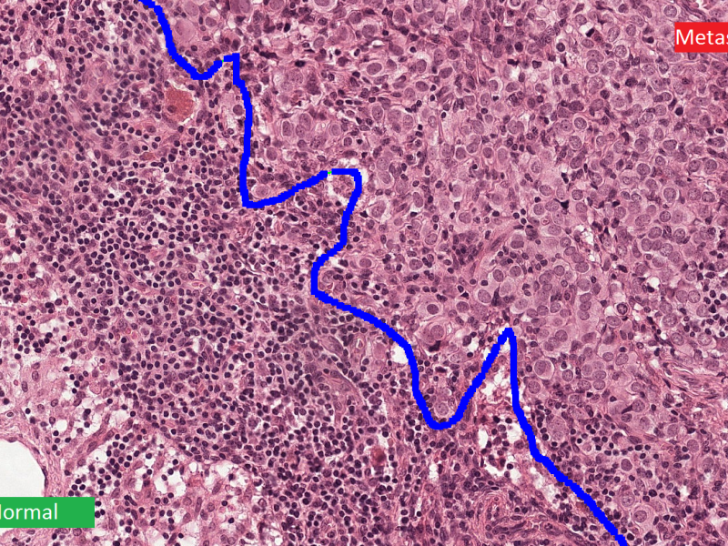 Uitzaaiingen (metastase) - data afkomstig uit het onderzoek van Bas Veeling